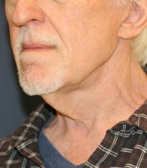Necklift 201 - before - oblique