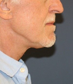 Necklift 201 - after - front