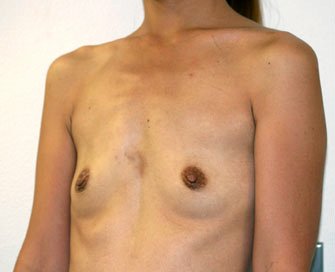 Breast Augmentation Case 28 - before - angle