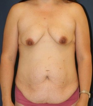 Mommy Makeover 201 - before - front