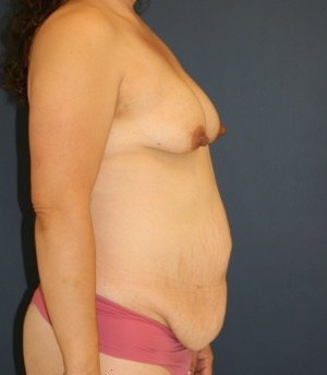 Mommy Makeover 201 - before - side