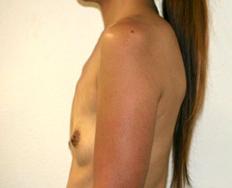 Breast Augmentation Case 28 - before - side