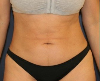 Tummy Tuck 201 - before - front