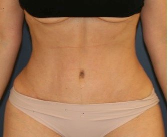 Tummy Tuck 201 - after - front
