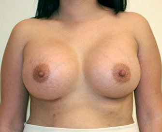 Breast Augmentation Case 29 - after - front