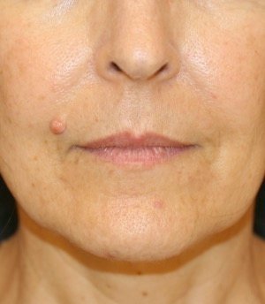 Lip Lift 201 - before - front