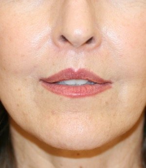 Lip Lift 201 - after - front
