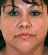 Rhinoplasty Case 2 - before - front