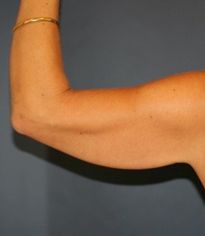 Arm Reduction 201 - before - back