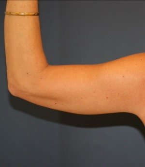 Arm Reduction 201 - after - back