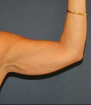 Arm Reduction 201 - before - front