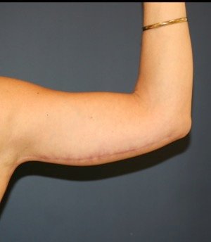Arm Reduction 201 - after - front