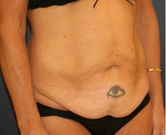 Tummy Tuck 203 - before - oblique