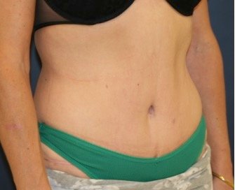 Tummy Tuck 203 - after - oblique