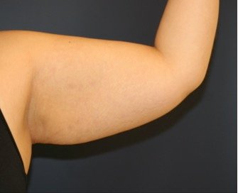 Arm Reduction 202 - before - back