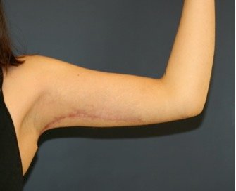 Arm Reduction 202 - after - back