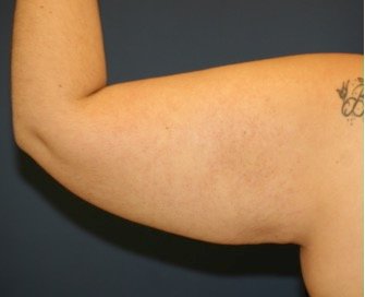 Arm Reduction 202 - before - front