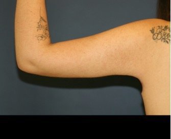 Arm Reduction 202 - after - front