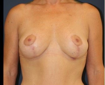 Breast Lift 301 - after - front