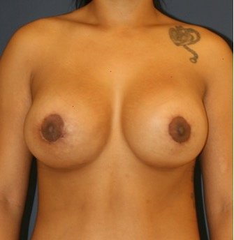 Breast Augmentation-Lift 50 - after - front