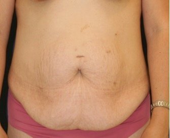 Tummy Tuck 205 - before - front