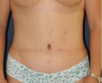 Tummy Tuck 205 - after - front