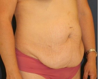 Tummy Tuck 205 - before - oblique