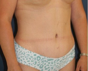 Tummy Tuck 205 - after - oblique