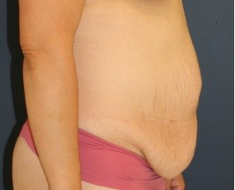Tummy Tuck 205 - before - side