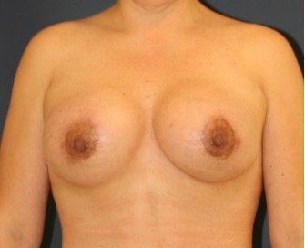 Breast Augmentation-Lift 51 - after - front