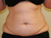Tummy Tuck Case 3 - before - front