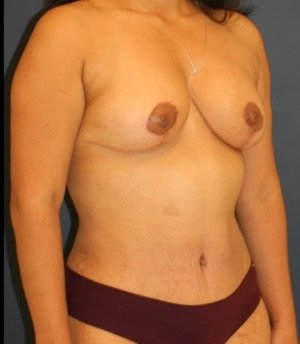 Mommy Makeover 204 - after - oblique