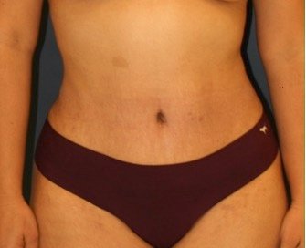 Tummy Tuck 206 - after - front