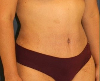 Tummy Tuck 206 - after - oblique