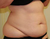 Tummy Tuck Case 3 - before - oblique