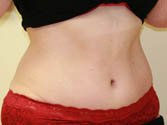 Tummy Tuck Case 3 - after - oblique