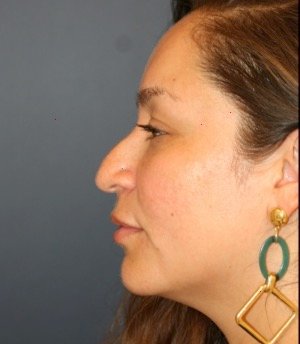 Rhinoplasty 200 - before - front