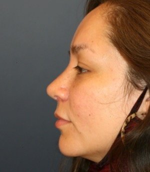 Rhinoplasty 200 - after - front