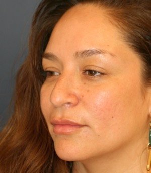 Rhinoplasty 200 - before - oblique