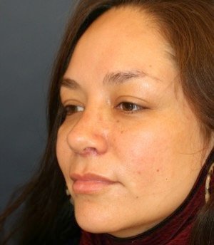 Rhinoplasty 200 - after - oblique