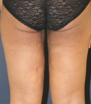 Thigh Lift 200 - after - back