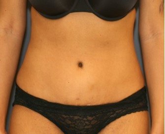 Tummy Tuck 207 - after - front
