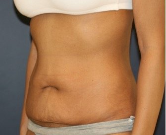Tummy Tuck 207 - before - oblique