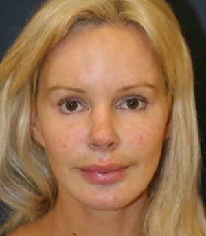 Browlift Foreheadplasty 100 - before - front