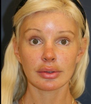 Browlift Foreheadplasty 100 - after - front