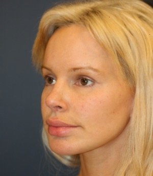 Browlift Foreheadplasty 100 - before - oblique