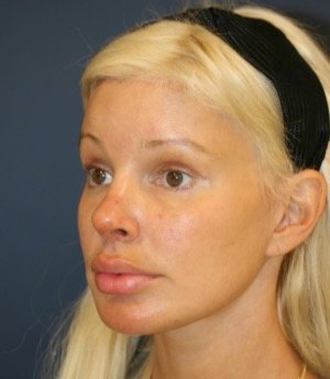 Browlift Foreheadplasty 100 - after - oblique