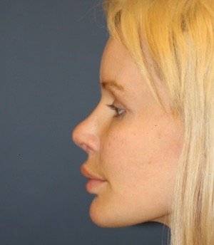 Browlift Foreheadplasty 100 - before - side