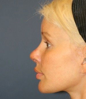 Browlift Foreheadplasty 100 - after - side