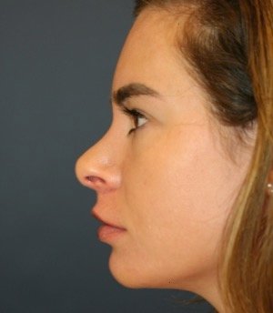 Revision Rhinoplasty 201 - before - front